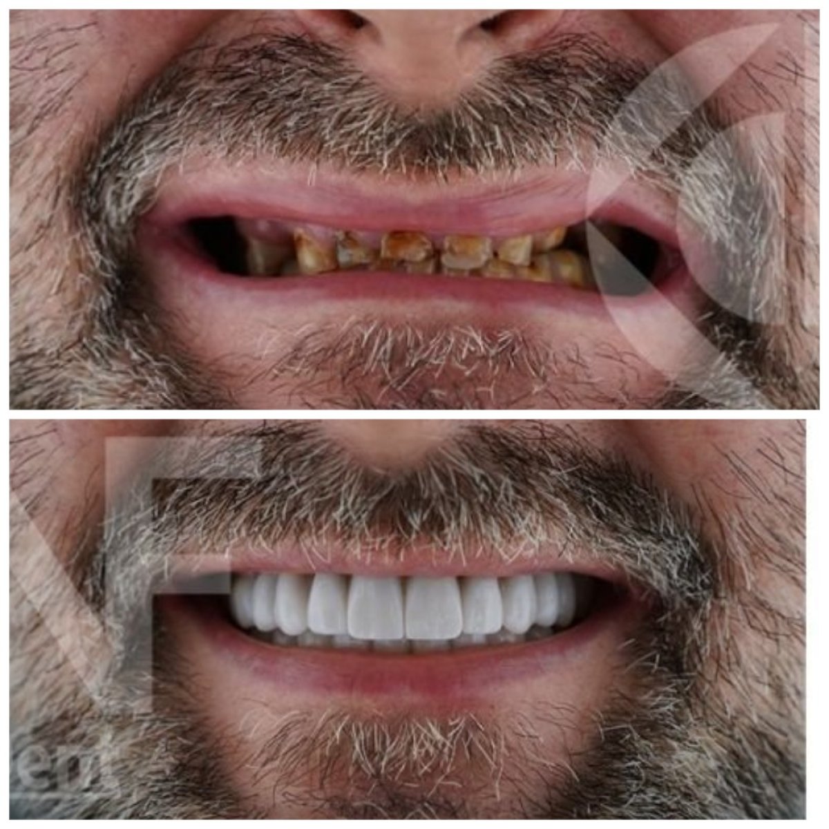 Résultats avant et après implants dentaires chez Nifa Dent International, sourire restauré