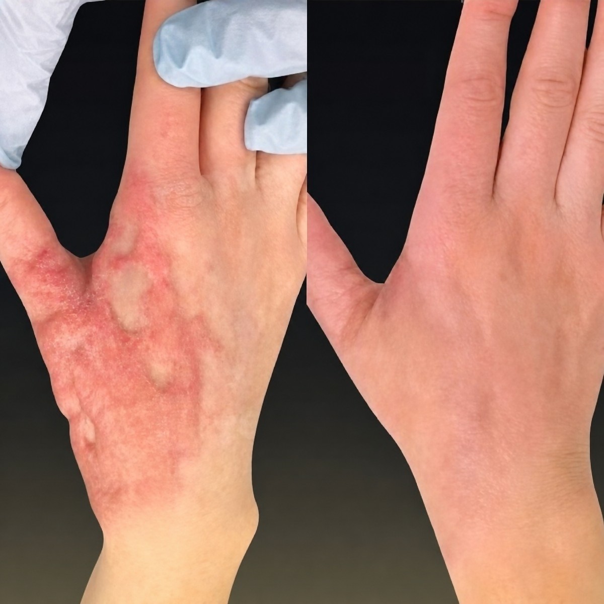 Before and after scar revision results on hand at Memorial Şişli Hospital, improved skin appearance