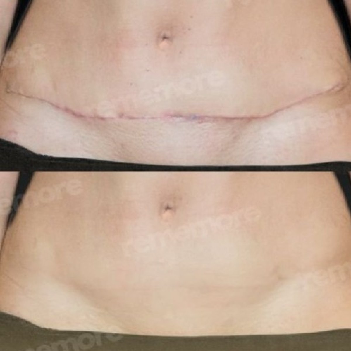 Scar revision before and after results at Memorial Şişli Hospital, improved abdominal scar