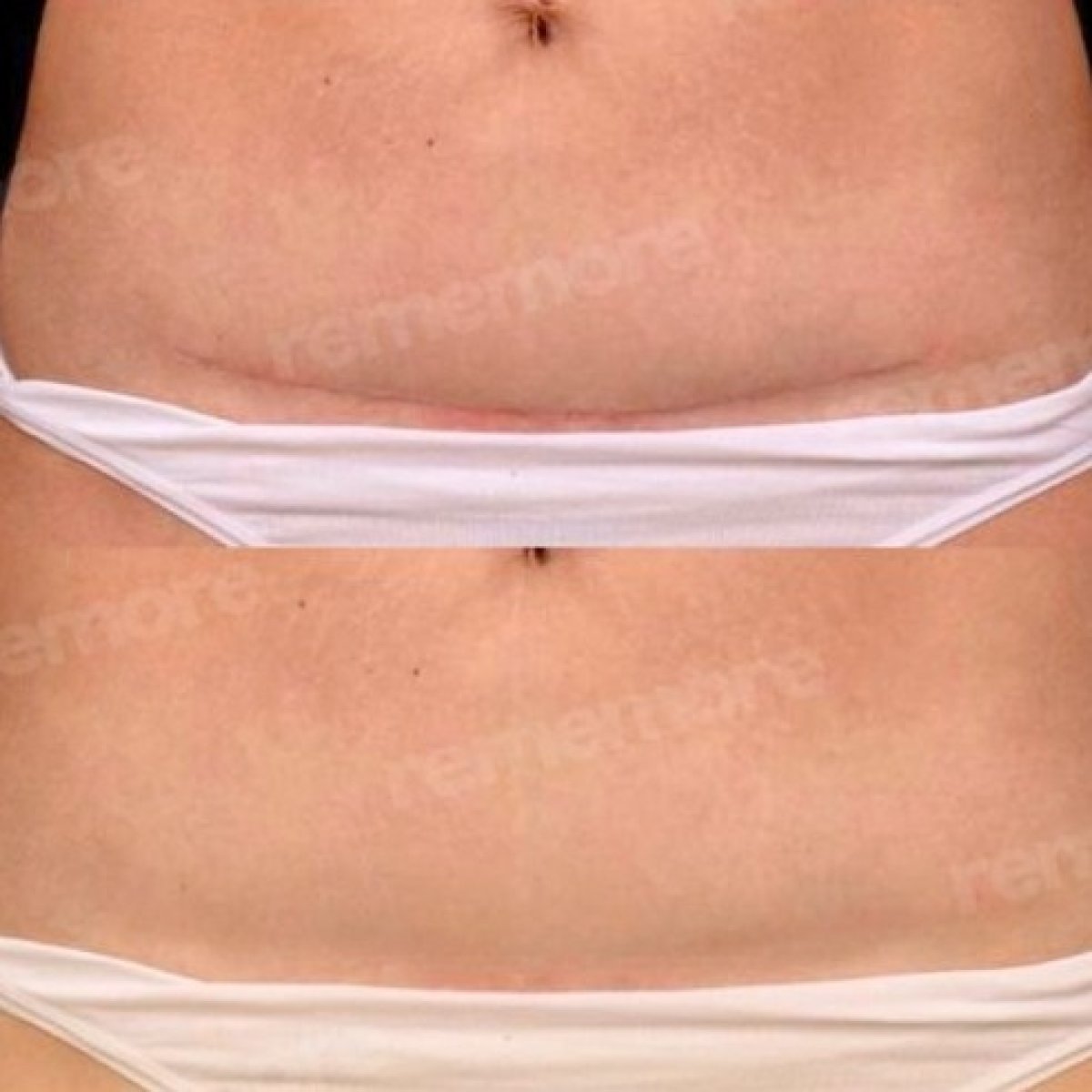 Resultados antes y después de la revisión de cicatrices en abdomen en Memorial Şişli Hospital