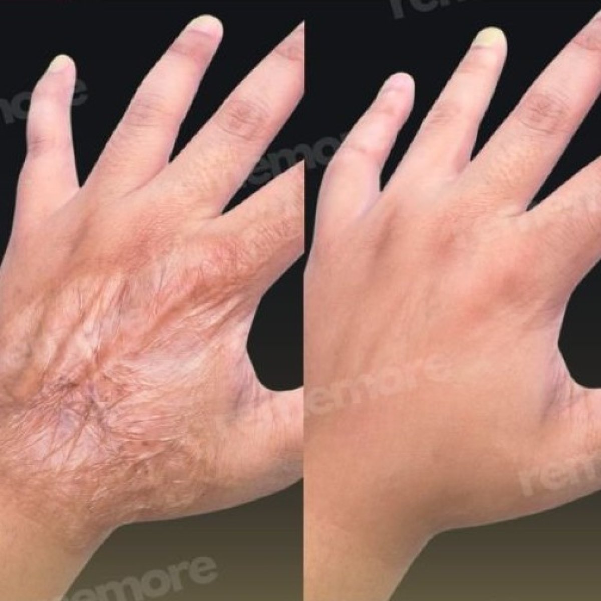 Before and after scar revision results on hand at Memorial Şişli Hospital, smoother skin