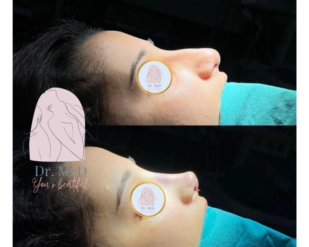 نتائج قبل وبعد تجميل طرف الأنف في Dr. MED، تحسين شكل الأنف