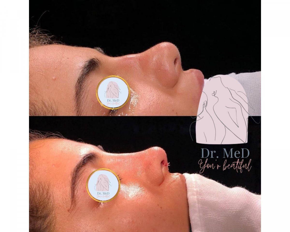 Resultados antes y después de rinoplastia de punta nasal en Dr. MED, punta refinada