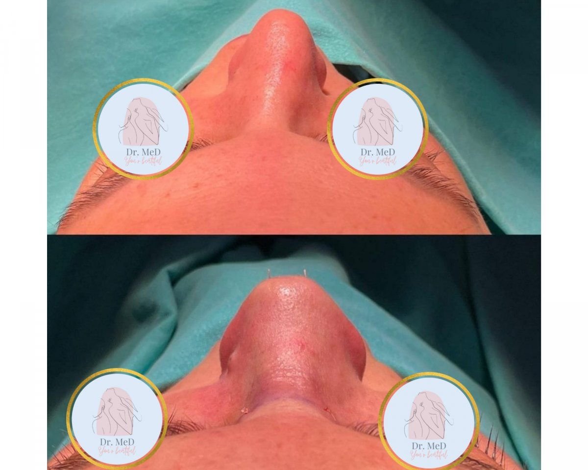 نتائج قبل وبعد تجميل طرف الأنف في Dr. MED، تحسين شكل طرف الأنف
