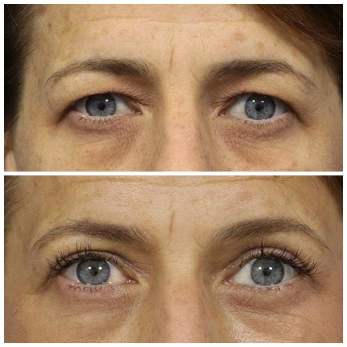 Resultados de blefaroplastia antes y después en TWT Health Clinic, corrección de párpados