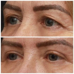 Premium Blepharoplasty (Eyelid correction) with All Included
