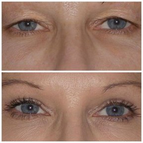 Premium Blepharoplasty (Eyelid correction) with All Included - photo 6