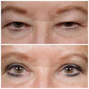 Premium Blepharoplasty (Eyelid correction) with All Included - photo 3