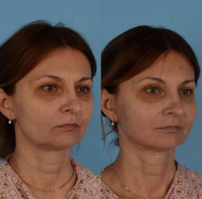 Premium Facelift surgery - photo 4