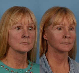 Premium Facelift surgery - photo 5