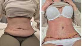 Before and after Липосакция живота photos by Dr. Aleksandra Luniewska 