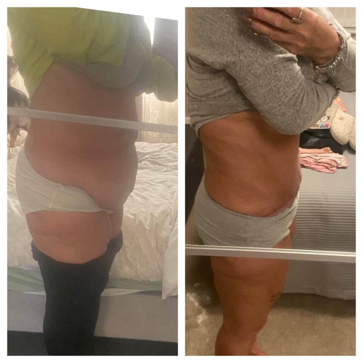 Before and after abdominal liposuction results at KCM Clinic, visible body contour improvement