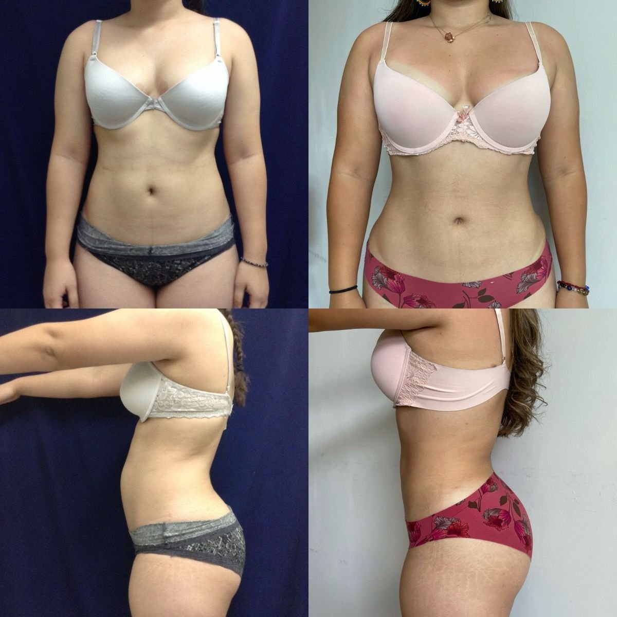 Resultados de liposucción 360 antes y después en Marroquín & Sandoval Plastic Surgery Clinic