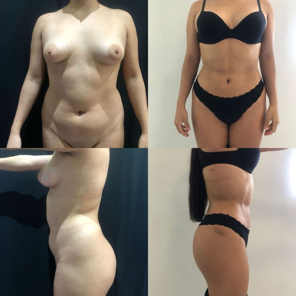 نتائج شفط الدهون 360 قبل وبعد في عيادة Marroquín & Sandoval للجراحة التجميلية