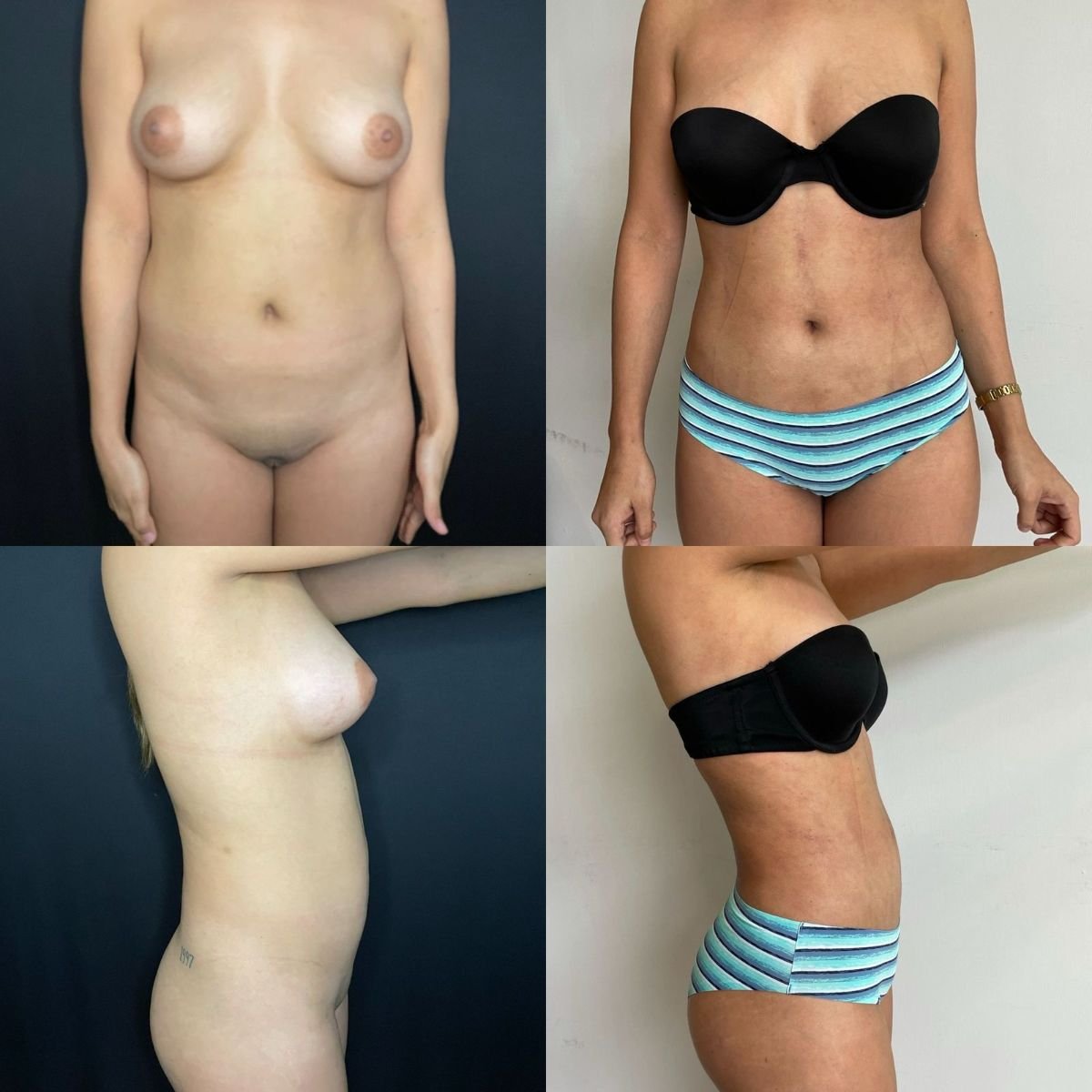 Resultados de liposucción 360 antes y después en Marroquín & Sandoval Plastic Surgery Clinic