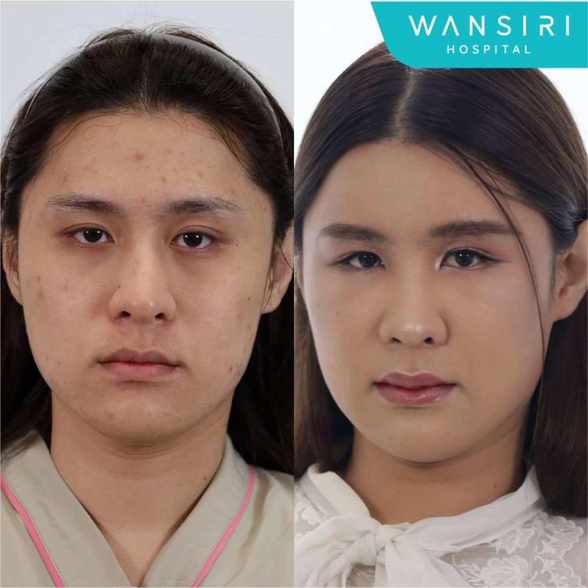 Resultados de lipofilling facial antes y después en Wansiri Hospital – mejora de volumen y piel