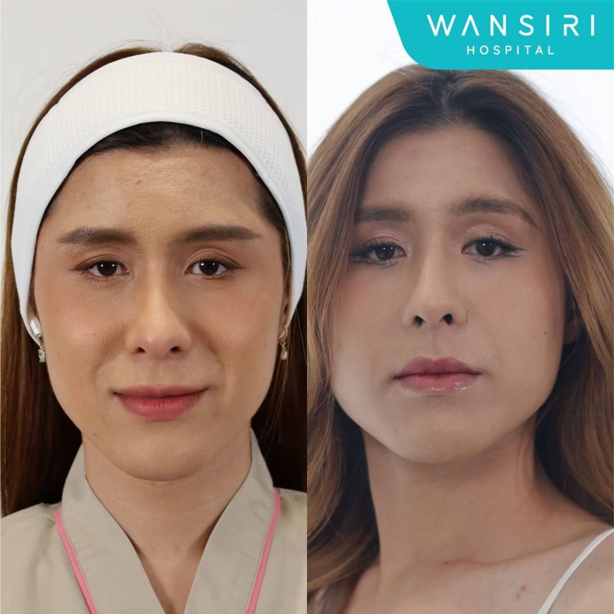 Résultats avant/après lipofilling visage à Wansiri Hospital, remodelage facial