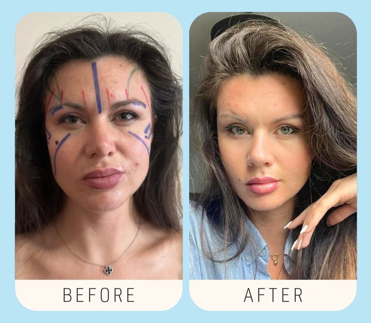 Antes y después de contorno facial en Estexper Clinic, mejora visible de los rasgos faciales
