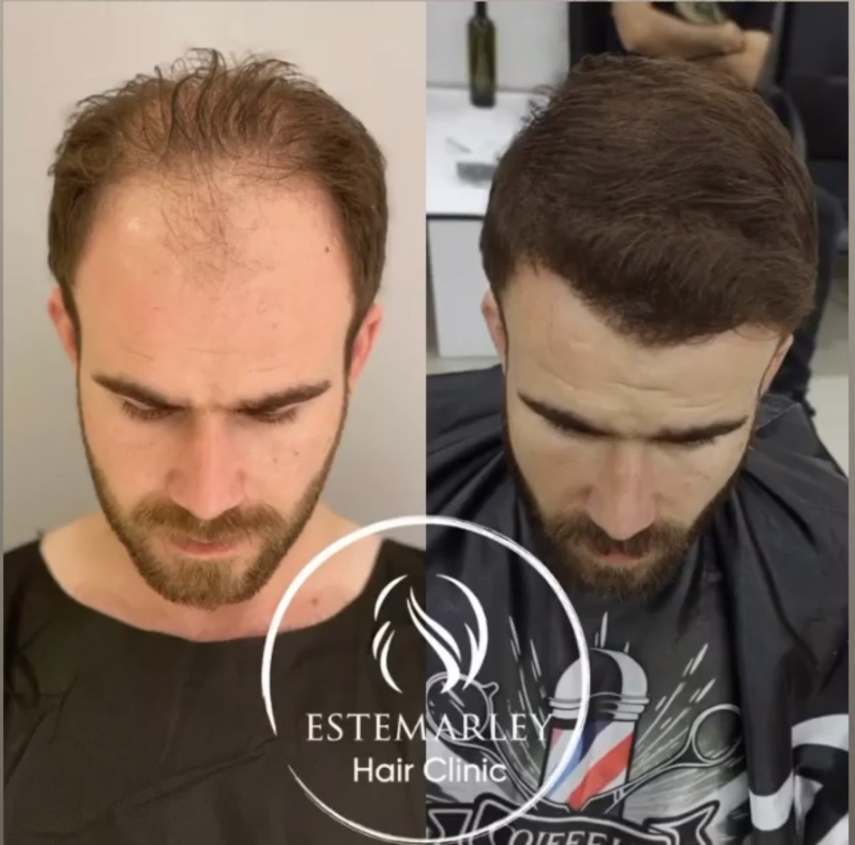 نتائج زراعة الشعر قبل وبعد في Estemarley – استعادة خط الشعر وكثافة أعلى