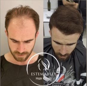 DHI Hair Transplant Premium Package - photo 5