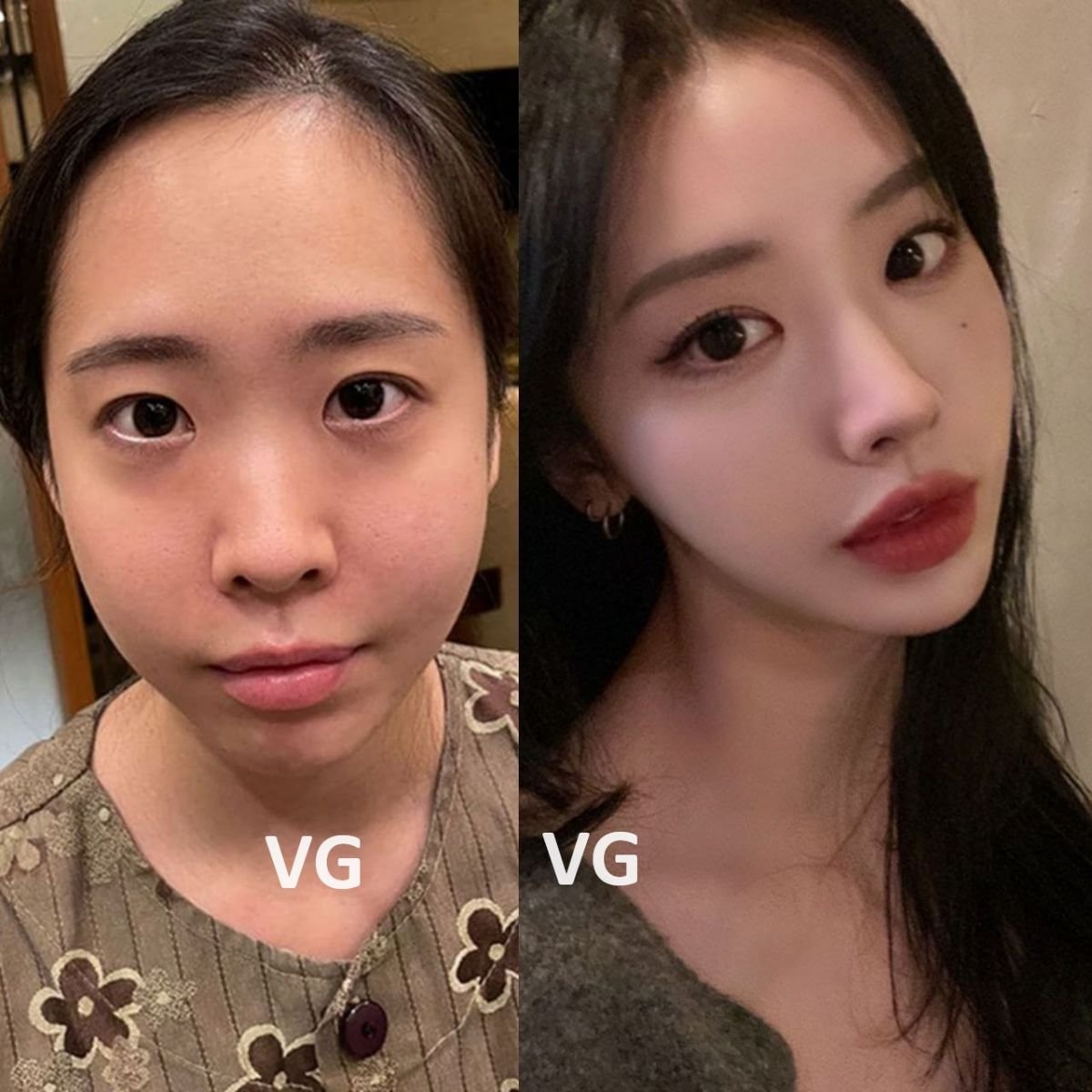 Antes y después de contorno facial en VG Plastic Surgery, mejora visible de mandíbula y mejillas