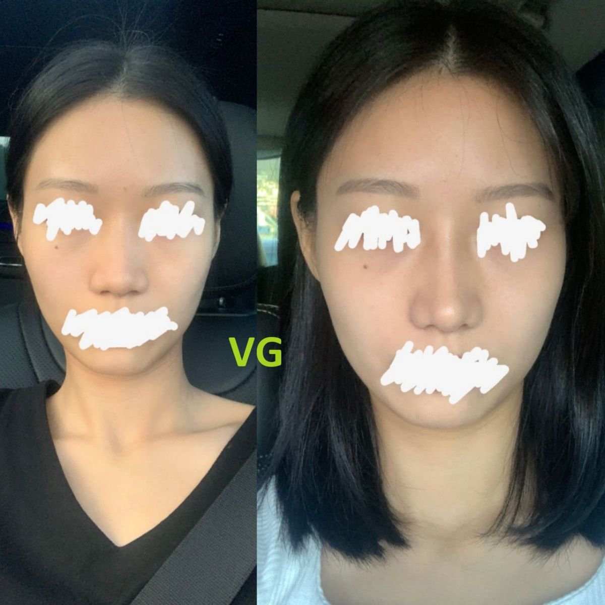 Resultados antes y después de septoplastia en VG Plastic Surgery para corregir tabique desviado
