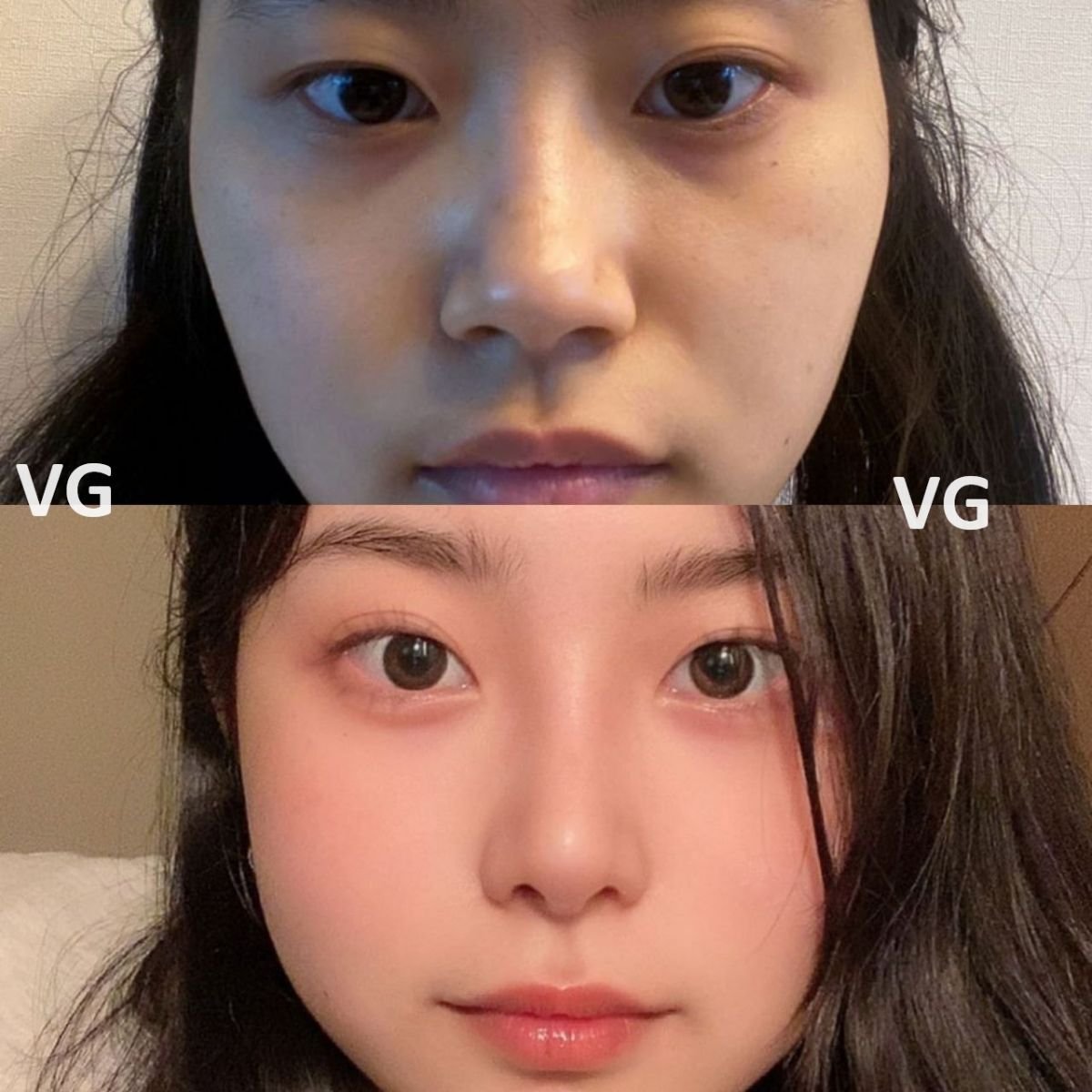 Antes y después de septoplastia en VG Plastic Surgery, mejor simetría y respiración nasal
