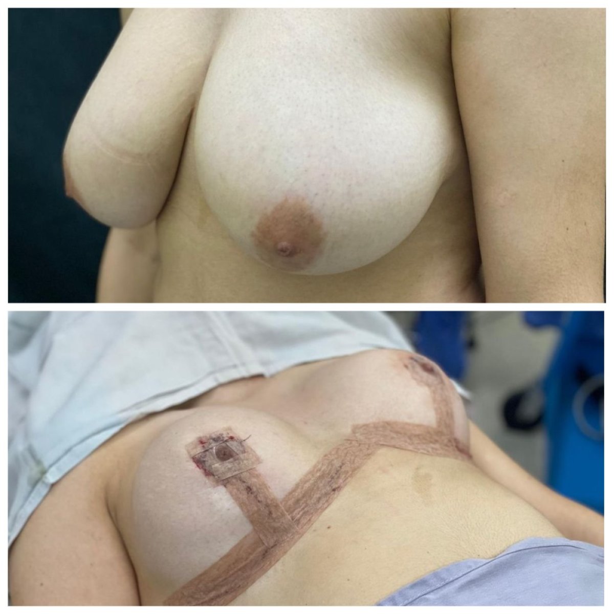 Before and after breast reduction results at Hospital Jardines, visible size and shape improvement