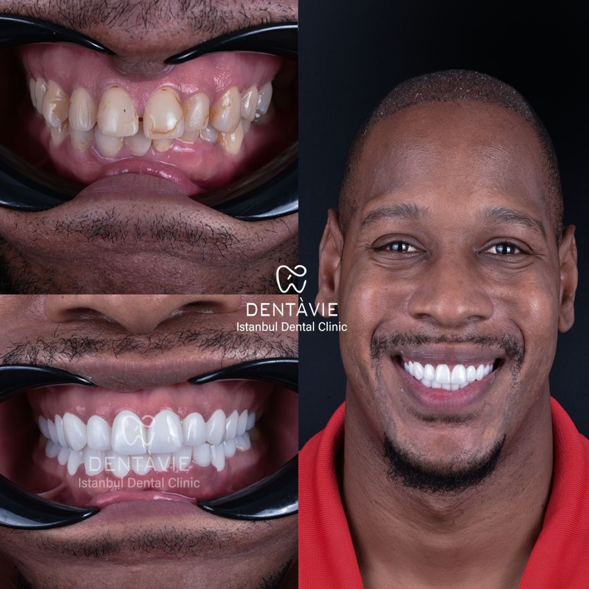 Hollywood Smile Vorher-Nachher-Ergebnis bei Dentavie Istanbul Dental Clinic, Smile Makeover