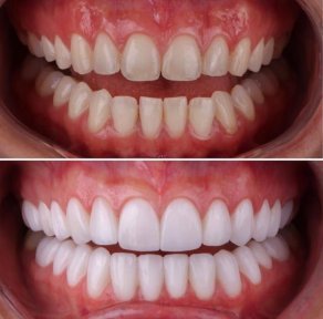 Hollywood Smile - photo 6