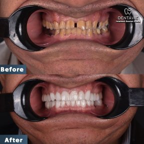 Hollywood Smile - photo 4