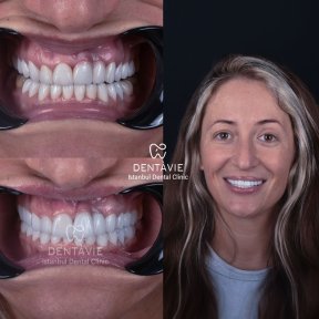 Hollywood Smile - photo 5