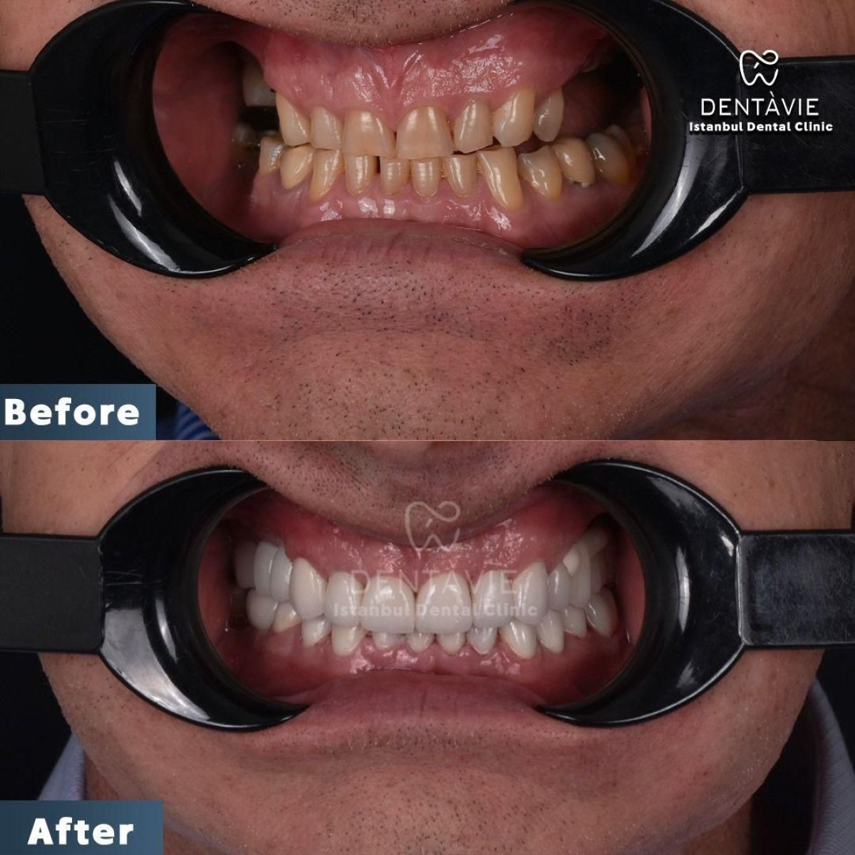 نتائج قبل وبعد ابتسامة هوليود في Dentavie Istanbul Dental Clinic، تحول الابتسامة