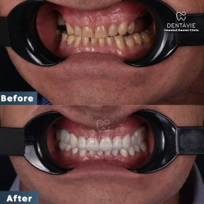 Hollywood Smile procedure with 24 zirconium crowns - photo 4