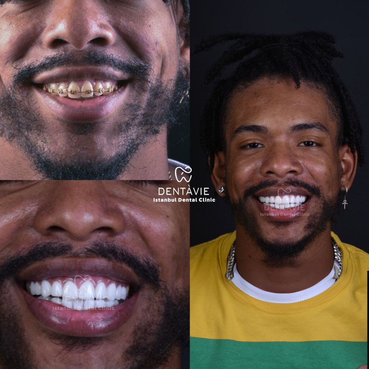 Resultados antes y después de Hollywood Smile en Dentavie Istanbul Dental Clinic, cambio de sonrisa