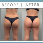 Before and after Вазер (Vaser) липосакция photos by Dr. Dr Phatcharasak Kraisornphongsakul Md
