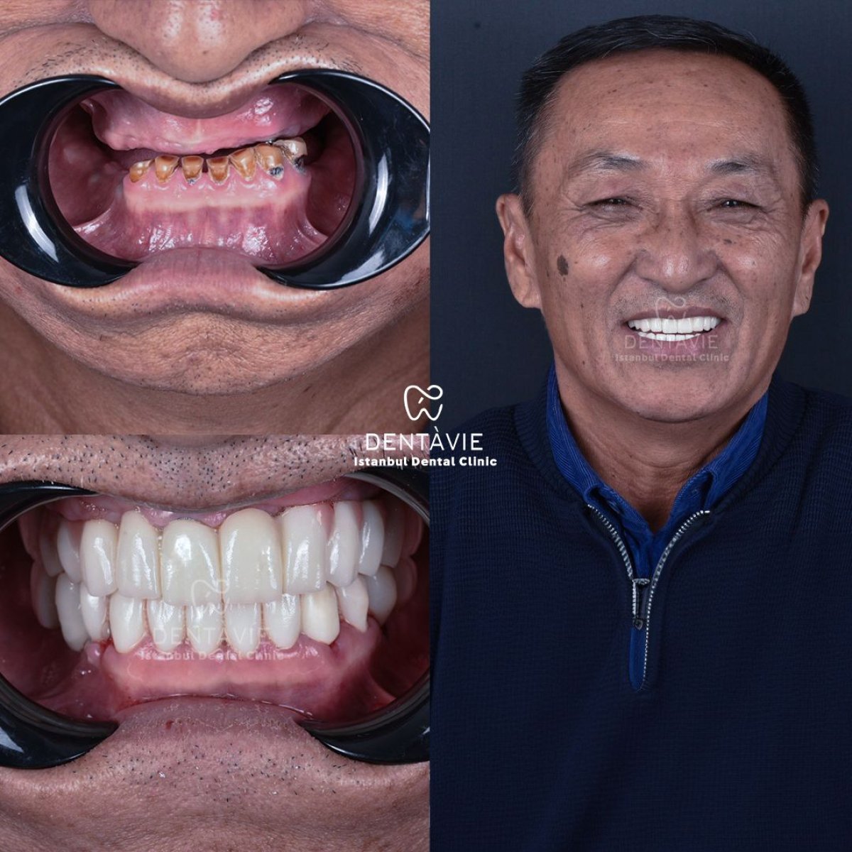 نتيجة قبل وبعد زراعة الأسنان All-on-6 في Dentavie Istanbul Dental Clinic، ابتسامة مستعادة