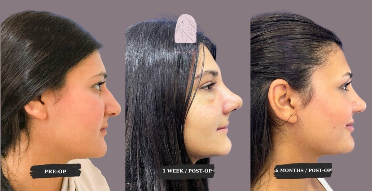 Tip rhinoplasty before and after results at Dr. MED – improved nose shape and profile