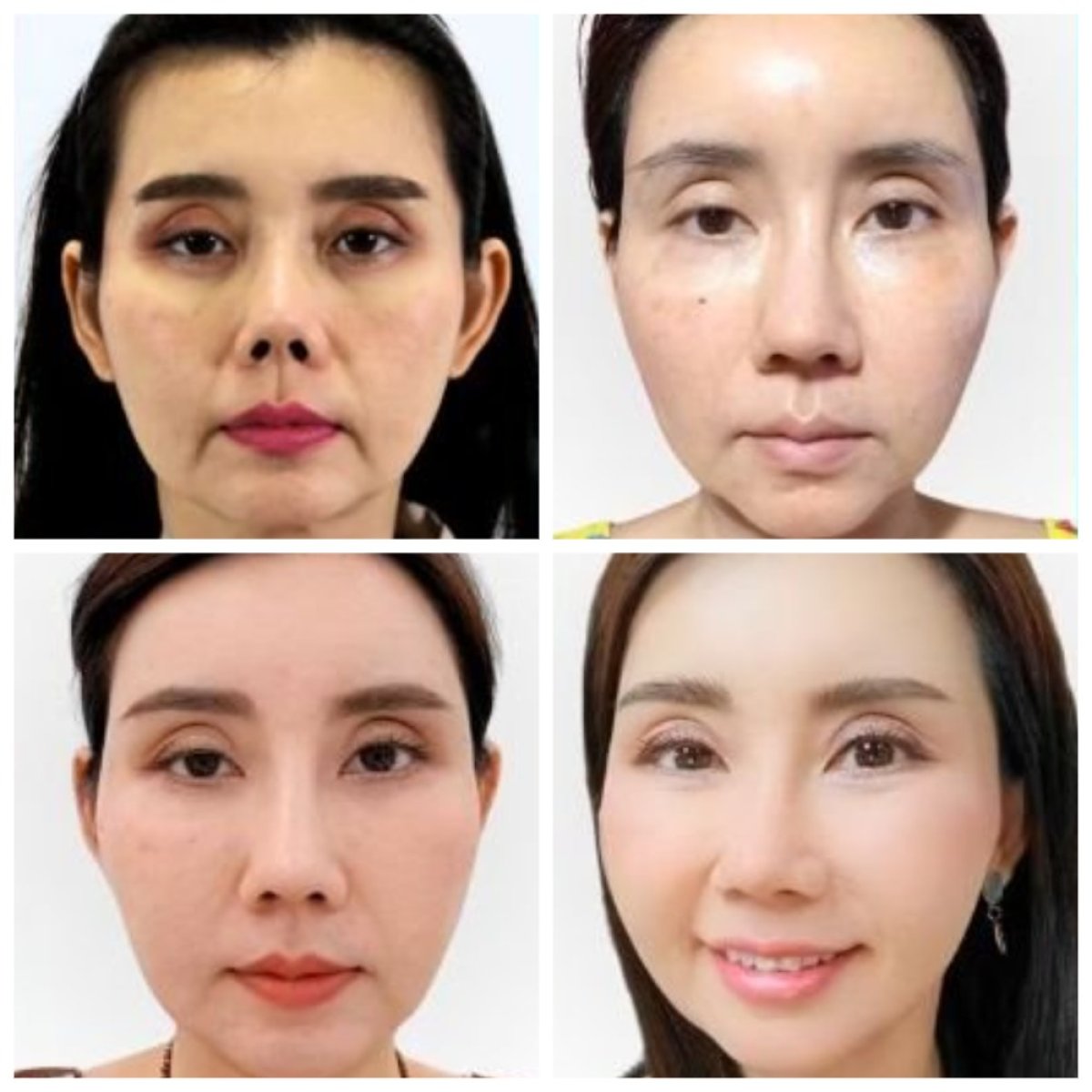 Resultados de lipofilling facial antes y después en Wansiri Hospital, rejuvenecimiento facial