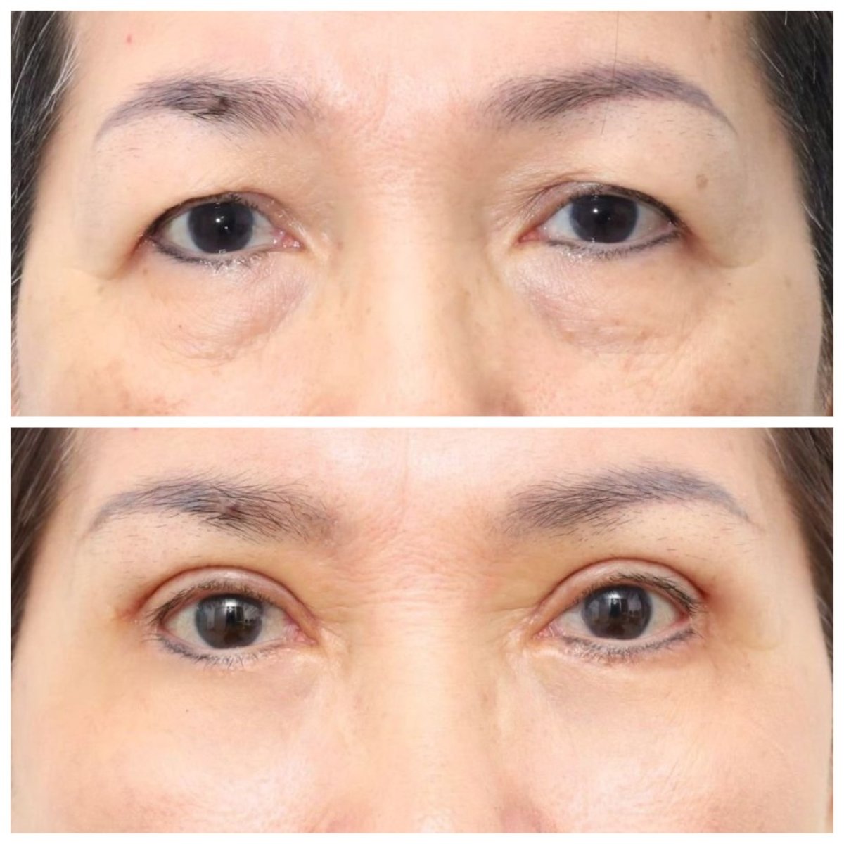 Antes y después de lipofilling bajo los ojos en Wansiri Hospital, menos bolsas y piel suave