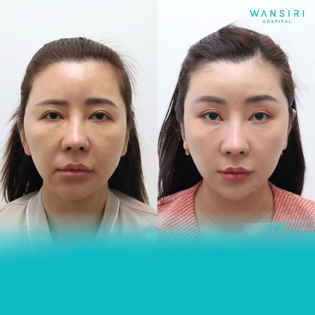 Before and after Fox Eye Lift results at Wansiri Hospital, enhanced eye contour and lift