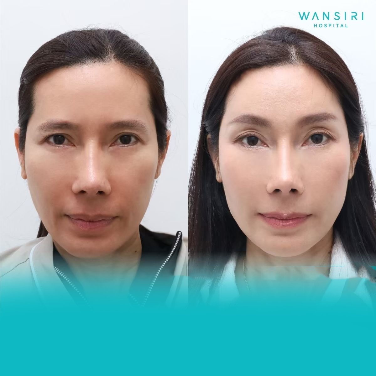 Before and after Fox Eye Lift results at Wansiri Hospital, enhanced eye contour and lift