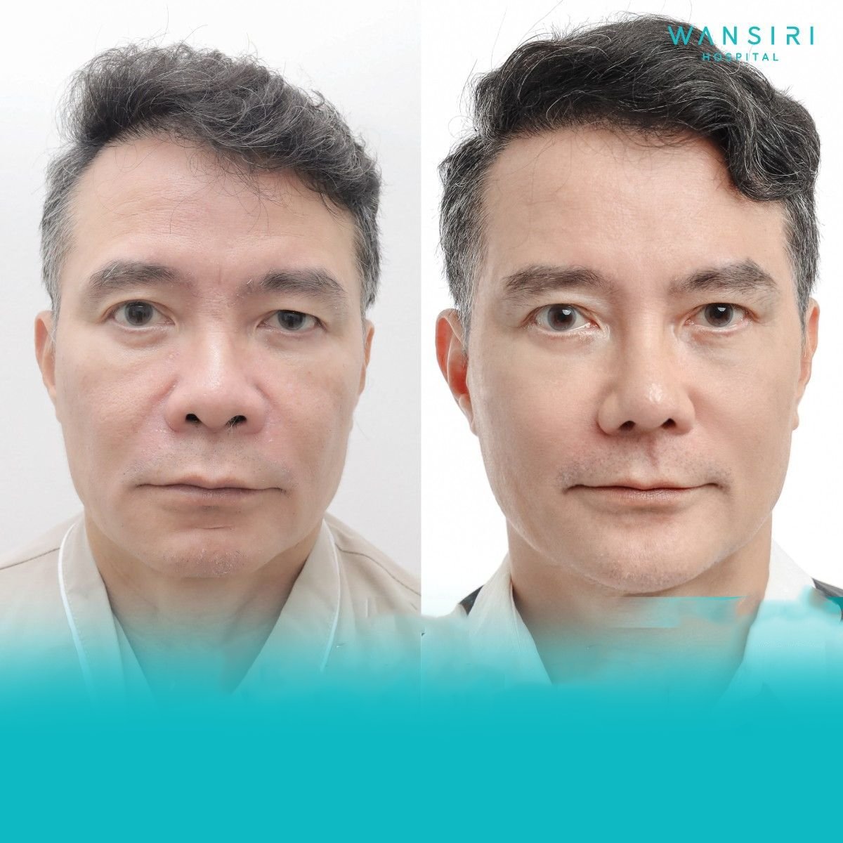 نتائج قبل وبعد Fox Eye Lift في مستشفى Wansiri – مظهر عيون أكثر شبابًا