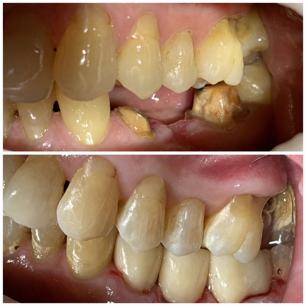 Результаты мини-имплантации зубов до и после в Smile Terminal Dental Care, улучшение прикуса