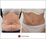 Before and after Липосакция живота photos by Dr. Aleksandra Luniewska 