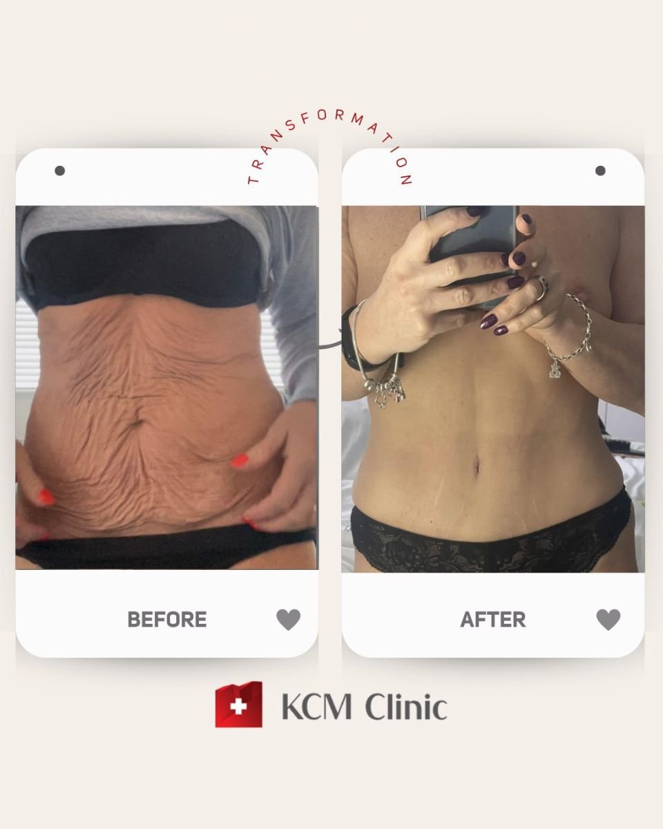 نتائج شفط دهون البطن قبل وبعد في KCM Clinic – تحسين شكل البطن