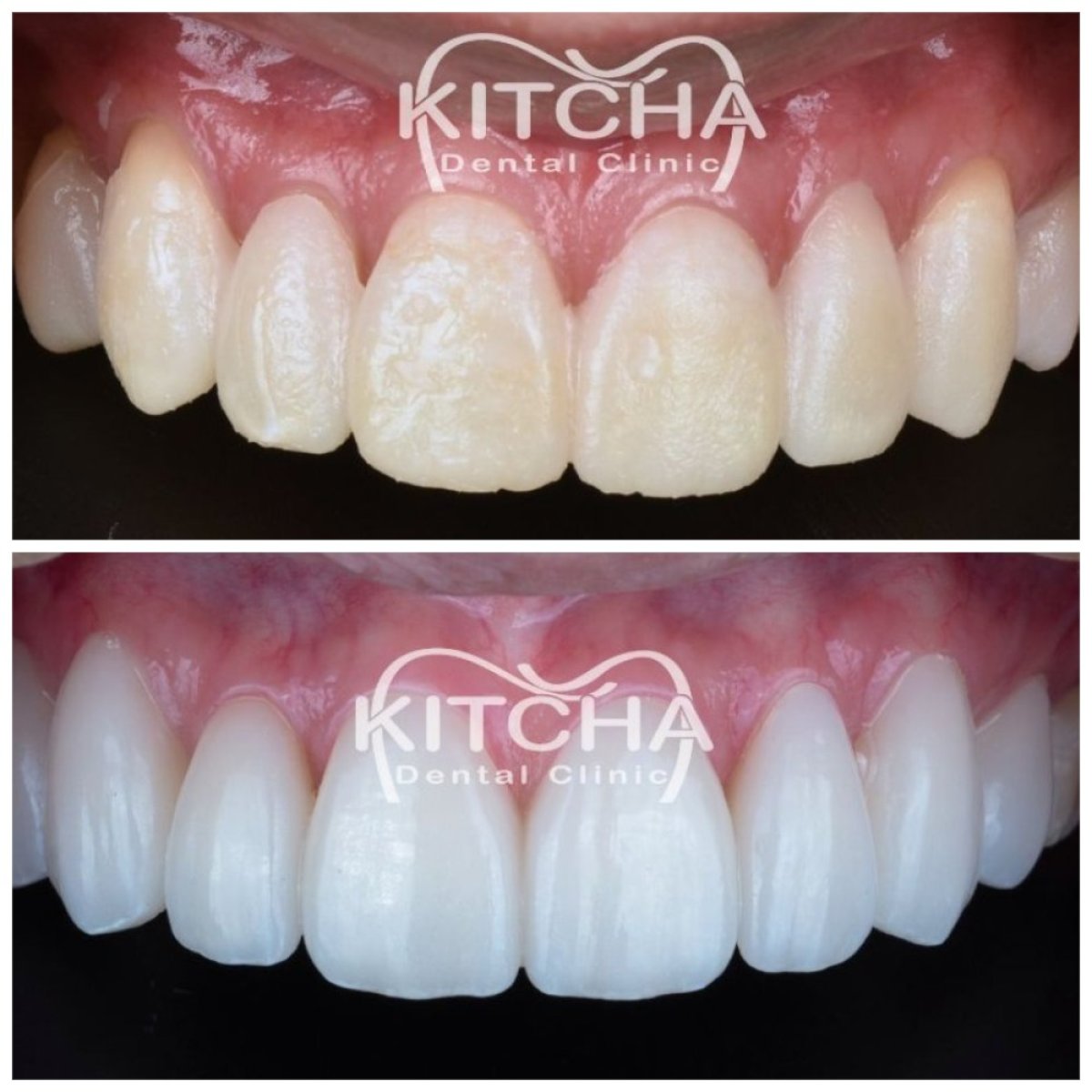 نتائج قبل وبعد عدسات الأسنان الخزفية في Kitcha Dental Clinic – ابتسامة أكثر بياضًا