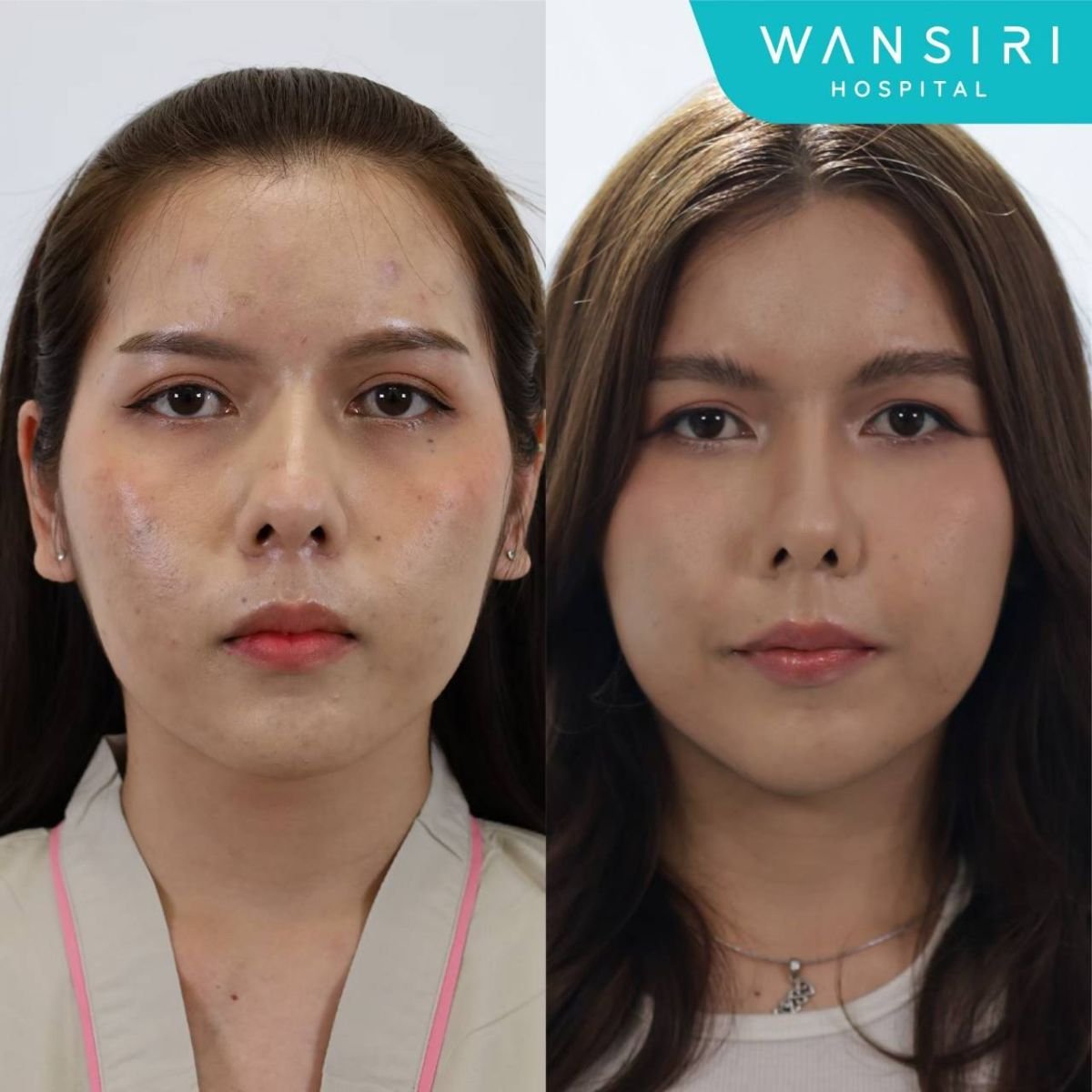 Before and after facelift results at Wansiri Hospital, facial rejuvenation and smoother skin