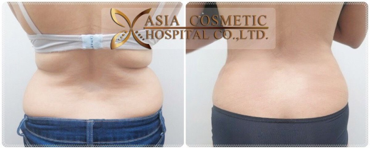 Before and after liposuction results at Asia Cosmetic Hospital, visible waist contour improvement