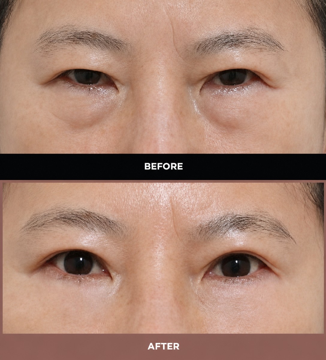 Before and after blepharoplasty results at URBAN Plastic Surgery, eyelid correction procedure